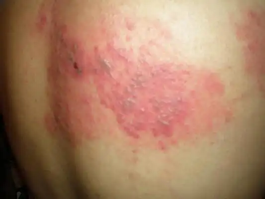 蛇缠腰早期症状图46