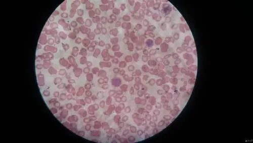 学涂片请教下面血涂片有原始细胞吗