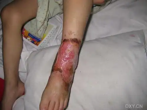 小儿足部皮肤缺损,怎么植皮比较好