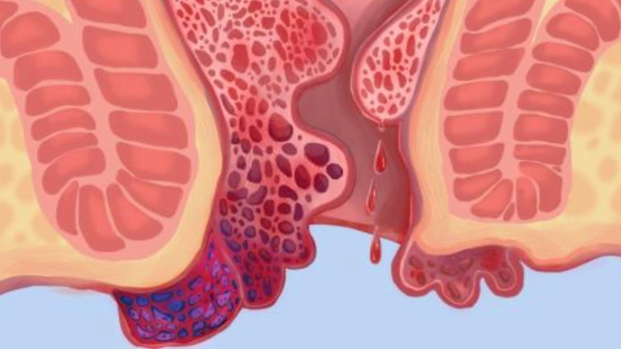 这种大便出血,不是痔疮而是直肠癌,一定要当心!