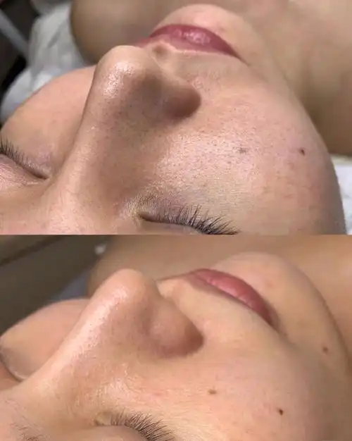 图全部仪器用品韩国进口最先进操作技术前后对比图#小气泡  #皮肤管理