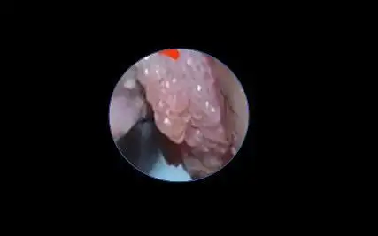 什么是外阴尖锐湿疣症状女性疣病是什么症状图片