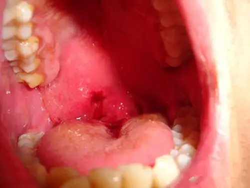 正常人的扁桃体图片