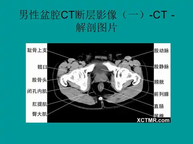 盆腔ct诊断课件