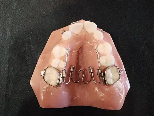 nitinol palatal expander(镍钛颚侧扩大器)