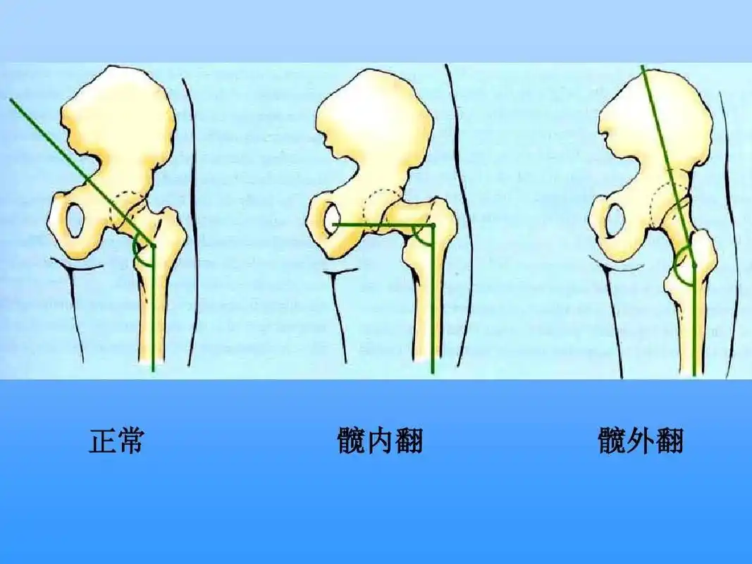 正常 髋内翻 髋外翻