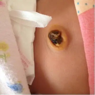 我们家宝宝出生16天了,肚脐这样,还不掉怎麼办