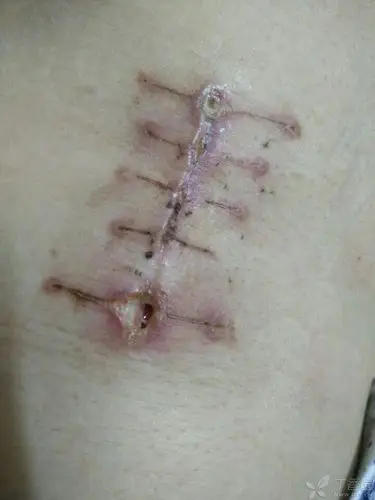 手术伤口拆线后感染怎么办