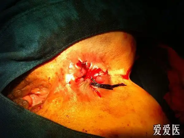 瘢痕体质能否行痔疮手术