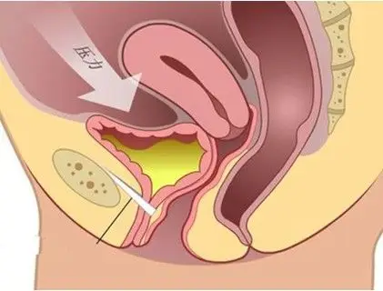 3%存在不同程度的阴道松弛问题的成年女性来说,这是一个亟待解决的