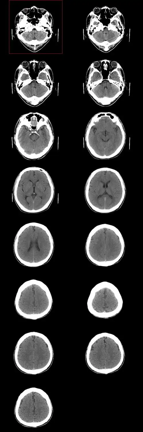 【随想】这个年轻人真的脑萎缩了?