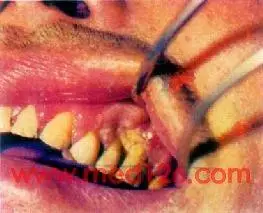 附图19 龈癌(左上牙龈)