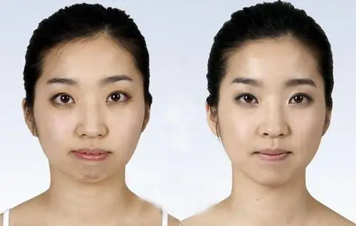 下巴后缩不适合注射玻尿酸