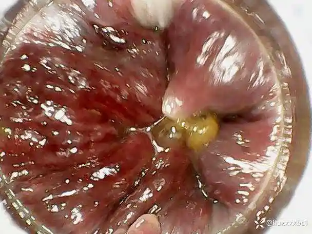 好多肛肠专家不相信,肛瘘内口会有三五个,今天就让大家看一下,眼见为