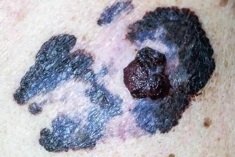 应该怎么判断自己的色素痣是良性的还是恶性的呢_痣_症状_治疗方法