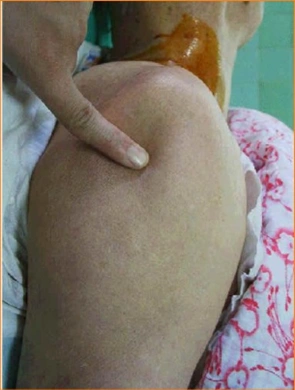 呈方肩畸形,在腋窝,喙突下或锁骨下可触及移位的肱骨头,关节盂空虚