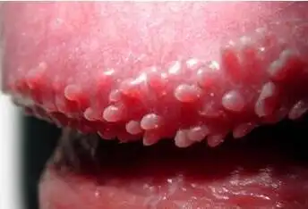 龟头冠状沟珍珠丘疹多见于 中青年男性,常出现1-3mm大小的丘疹,乌于