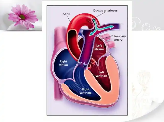 动脉导管未闭课件