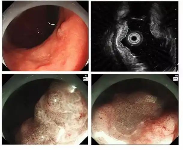 4个精彩病例,带你了解早期胃癌(有图有真相)