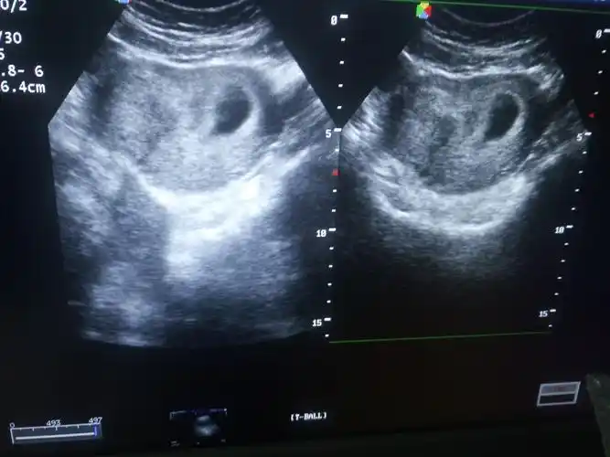 鞍状子宫?新手求科普 - 超声医学讨论版 - 爱爱医医学论坛