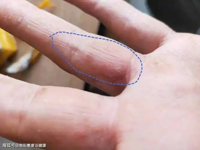 夏天一到,手上冒出一堆小水泡是怎么回事?