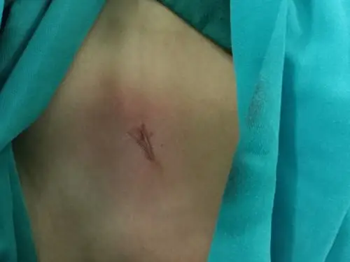 太和县人民医院疝气专科 微创治愈疝气,不住院,不缝针,刀口小,恢复快