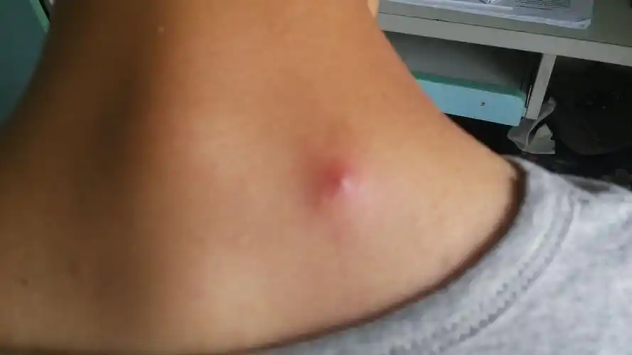 问:皮肤出现红肿