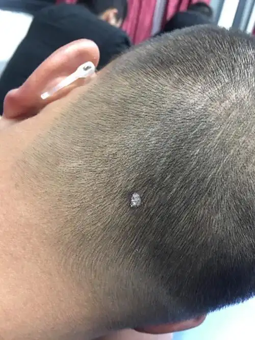 头皮上长了一个东西 硬但是不疼不痒 求好心人解答