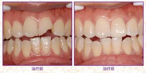 门牙有部分缺损怎么补牙