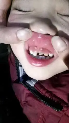 小孩子上牙龈上什么