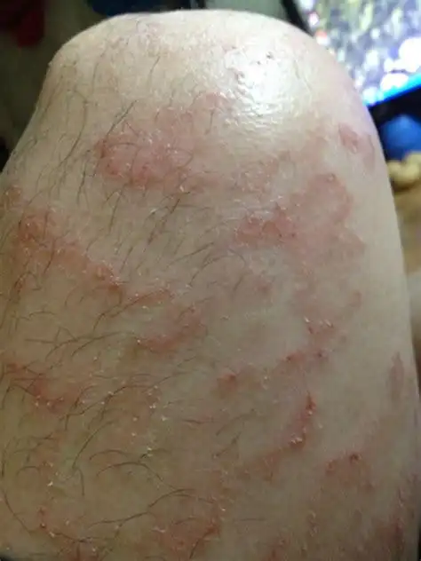 它是一种皮肤浅表慢性真菌感染(糠秕孢马拉色菌),多发生在皮脂腺发达