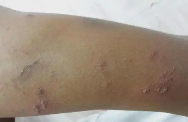 女子被"毁容"!毒液堪比硫酸!|虫子|蚊子|药膏|隐翅虫_网易订阅