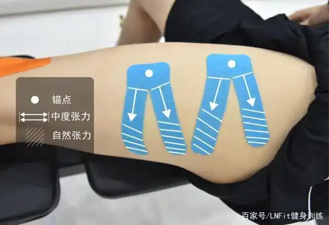 锚点贴在大腿外侧痛点处,贴布施加中度张力向两侧贴去,将2-3条y字贴
