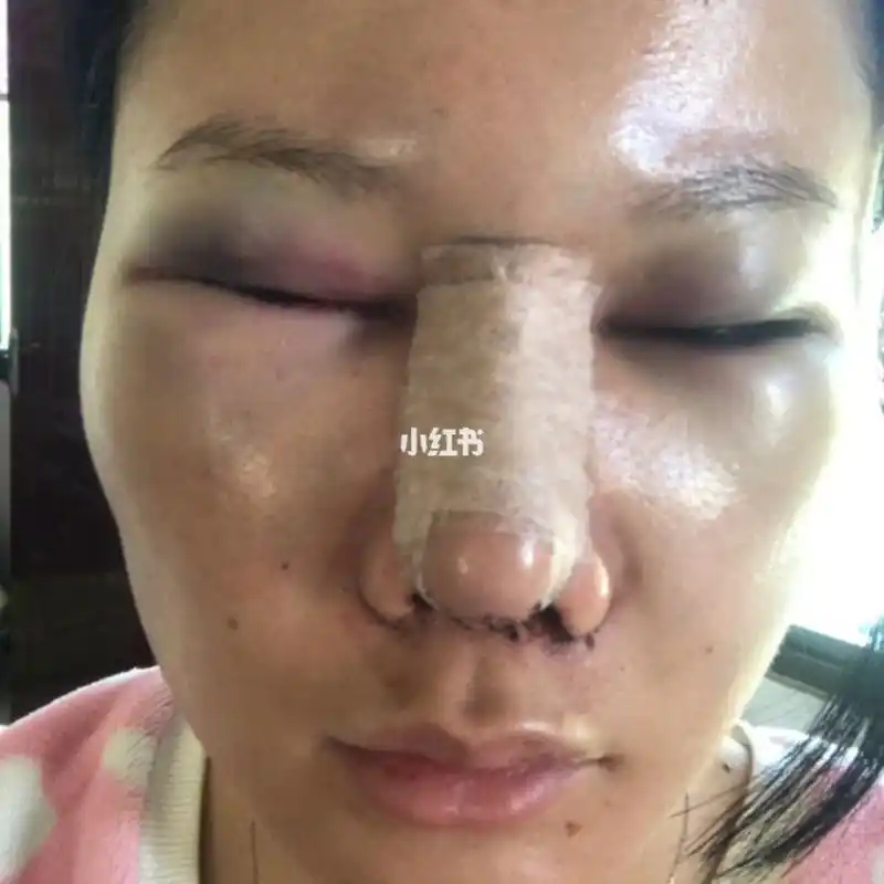 7515本人鼻子整容失败真实案例7515 图一是现在取出假体后