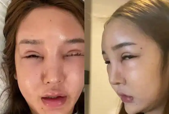 网红桃花宝宝整容上瘾嘴歪眼斜吓死人