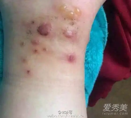 林妙可拍戏被毒虫咬伤夏季被毒虫蛰伤如何处理