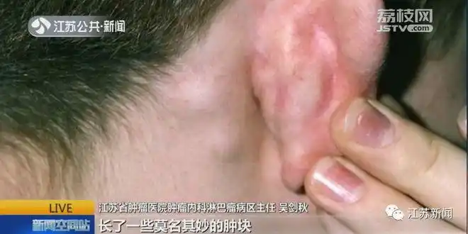 淋巴瘤善于"伪装",早期往往没有特异症状,"颈部,腋下,体表,包括口腔