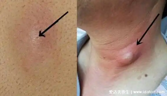 皮脂腺囊肿粉瘤图片及症状,感染后红肿疼痛严重影响美观