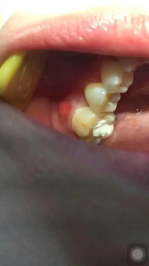 左下后牙根尖周炎