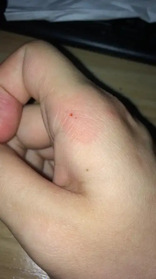 被家养猫咬出血,就是一个红点,和它玩的时候张嘴咬的,但是没用力,但