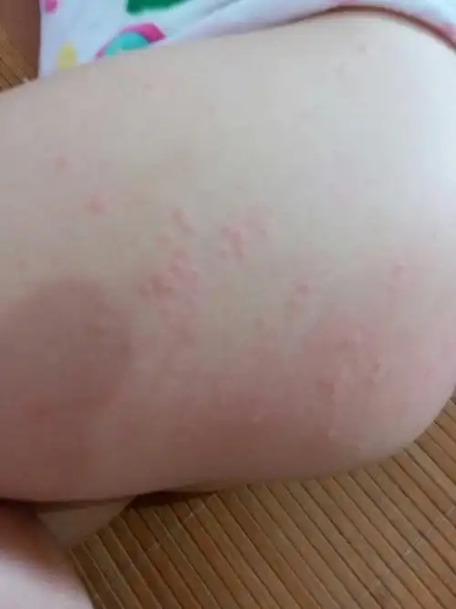 宝宝屁股到大腿之间长了好多红点,很痒.大家知道这是什么吗?