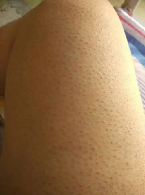 毛孔堵塞,腿上都是小红疙瘩,天生的从小就有,请问这是毛孔闭塞症吗,有