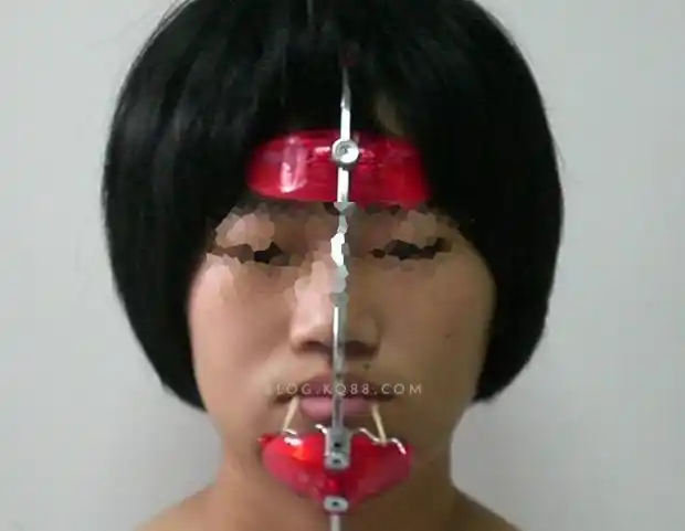 上颌前方牵引矫治病例--陈育松_kq88口腔正畸网