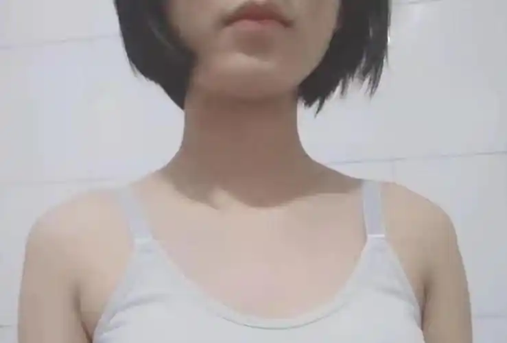 花季少女遭遇甲状腺癌微创手术让其完美如初