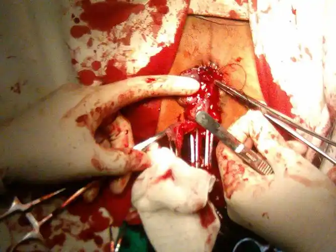 pph 嵌顿痔外痔部分环切,图片如下,欢迎大家讨论指导!