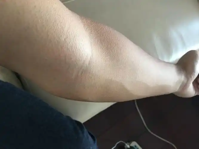 手臂外翻 当兵可以吗 初检过了 还有复查 复查跟初的一样嘛