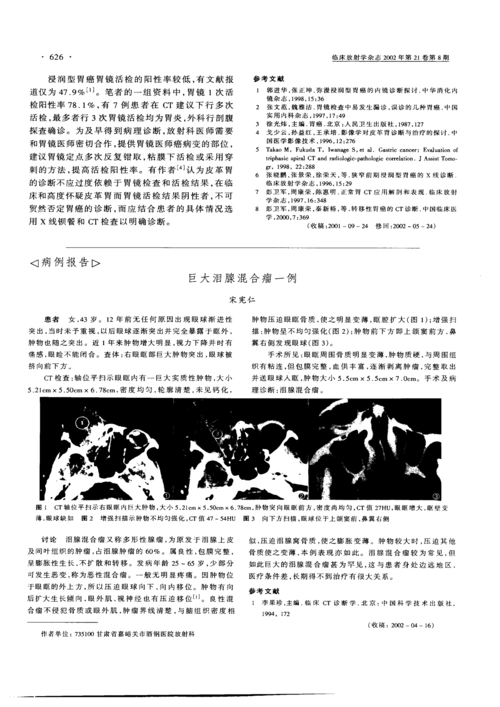 巨大泪腺混合瘤一例