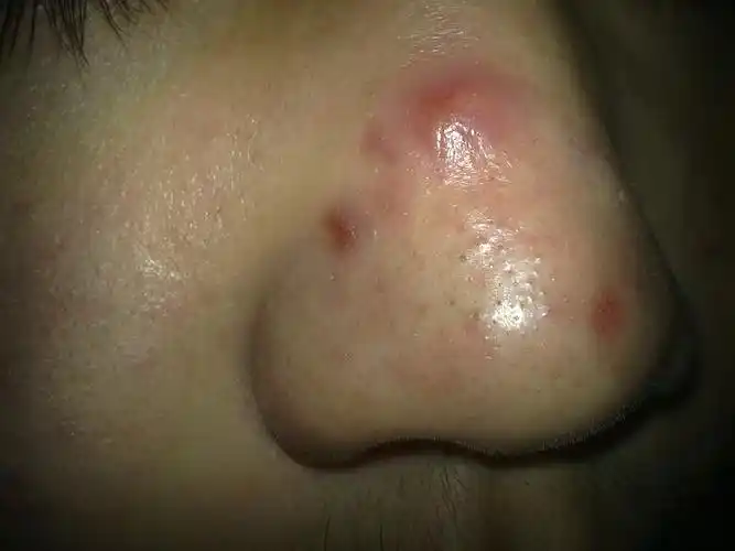 我的鼻子上老是长脓包怎么办啊,而且长了一个又一个.鼻子上又有黑头.