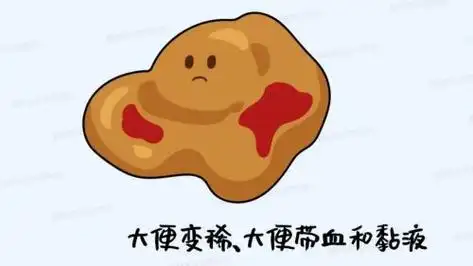 大便突然变细了,是肠癌吗?