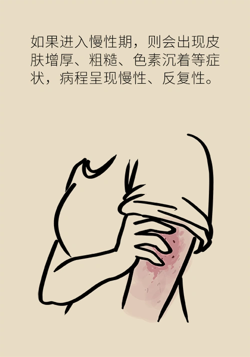 一到夏天痒痒痒!湿疹反反复复,祛湿到底有用吗?_腾讯新闻